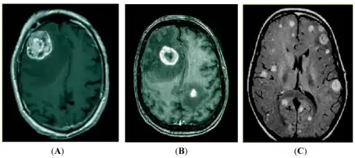 a-c)Magnetic resonance imaging (MRI) detection of brain metastasis