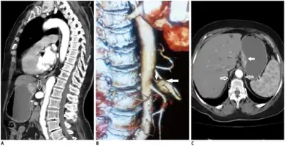 Median arcuate ligament syndrome-a)Stenosis and aneurysm of celiac artery because of  compression arrows b)severe stenosis and poststenotic dilatation white arrow c) median arcuate ligaments  arrows and gastric mucasal thickening
