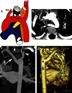 Left aortic arch with an aberrant right subclavian artery -a) Illustration, b)CT scan, c) MIP coronal image, d)coronal reconstructed 3D volume-rendered image