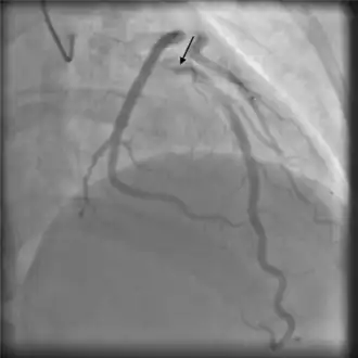 Angiographic image-contrast was seen to swirl and stay longer than usual, consistent with self-limiting spontaneous coronary artery dissection