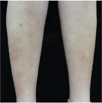 Indurated, slightly erythematous plaques on bilateral lower leg