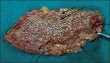Cut-opened specimen of gallbladder (strawberry) shows multiple polyps