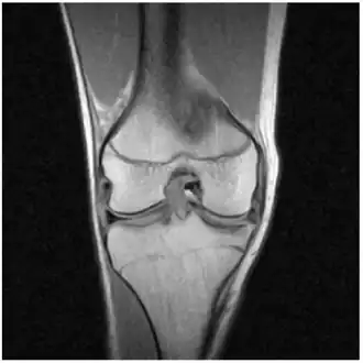 MRI of right knee revealing intra-articular and bucket-handle medial meniscus tear with the displaced fragment located in the intercondylar notch.
