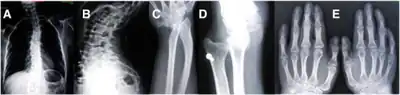 (A) AP plain X-ray of the spine demonstrating dorsal and lumbar scoliosis. (B) Lateral plain X-ray of spine showing severe lumbar lordosis. (C) X-ray film of right forearm evidencing distal bowing of the radius. (D) AP plain X-ray film of right forearm showing radius dislocation and radial-cubital dissociation. (C) AP plain X-ray film of hands demonstrating short 4th and 5th metacarpals.