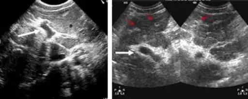 Ultrasonographic images in hepatic schistosomiasis