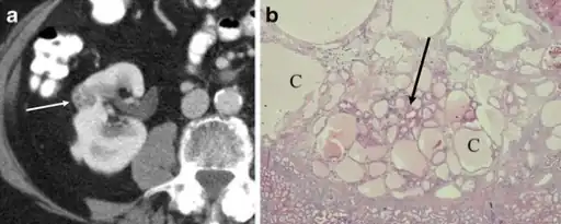 a,b)Renal oncocytoma with cystic change.