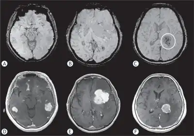 Primary central nervous system lymphoma a) Grade 1: multifocal tumors show no intratumoral susceptibility signal b) Grade 2: shows punctate low-intensity signals arrows c) Grade 3: low-intensity signals circle  d,e,f) shows primary central nervous system lymphomas with intense enhancement