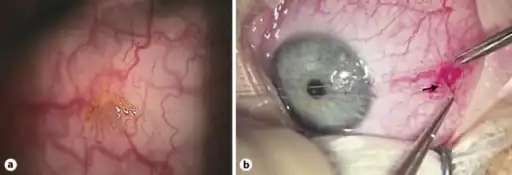 a) Paralysis tick attached to right temporal bulbar conjunctiva b)surgical removal of the larval tick