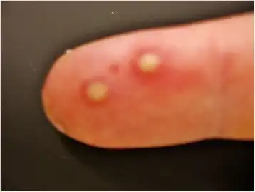 Palmar side , shows two yellowish vesicles.