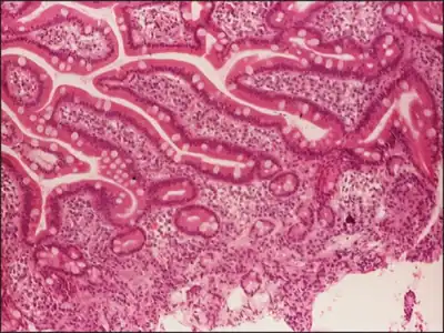Numerous hairy cells admixed with other elements