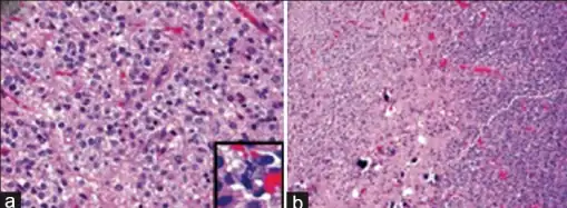 a)Anaplastic oligodendroglioma shows uniform cellularity, and perinuclear halos b)secondary features of oligodendroglioma include scattered microcalcifications
