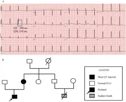 Pedigree of the short QT syndrome family a) ECG of the proband b) family investigation