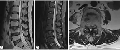 b,c,d) MRI present a minimal Schmorl's node at L4