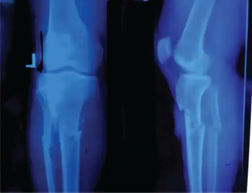 Knee showing tibial tuberosity avulsion fracture (and proximal tibial fracture)