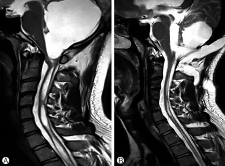 a)Large cystic mass at the posterior fossa with compression of the 4th ventricle b) postoperative MRI, a residual cyst and syringomyelia was decreased.
