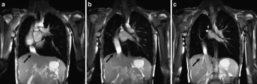 a-c) Scimitar syndrome in a young male- Breath-hold coronal 2-D steady-state free precession demonstrates the anomalous partial pulmonary venous return