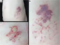 Nicolau syndrome associated subcutaneous glatiramer acetate injection a) Nicolau Syndrome on left abdomen b) erythematous, purpuric and haemorrhagic patch, at site of subcutaneous glatiramer acetate c) 3 weeks after GA injection livedoid patch disappeared