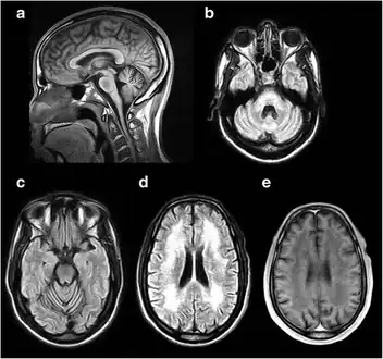 a-e) MRI of the brain demonstrating characteristic findings in DRPLA