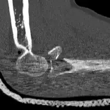 CT scan demonstrating the Mason type III radial head fracture