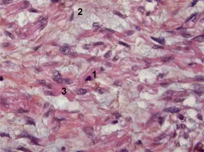 Myxoid leiomyosarcoma of bladder- 1) Abnormal mitosis 2) differentiated leiomyosarcoma  3) pools of hyaluronic acid