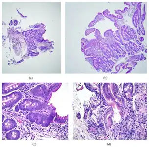 a,b)Moderate/severe shortening of most villi  c)focal superficial epithelial d)  crypt architectural changes.