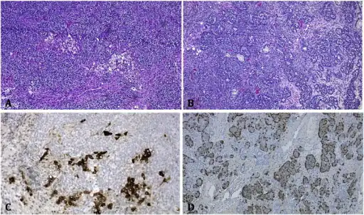 Staining of Sertoli–Leydig cell tumor a)Intermediate grade with hepatoid differentiation b)carcinoid tumor c) positive in the area of hepatoid differentiation d) positive in the carcinoid tumor