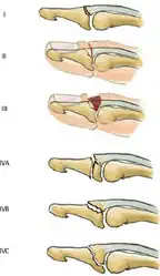 Doyle classification of mallet fingers