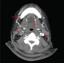 Axial CT slice at the level of C2-C3 soft tissue window setting setting. Extensive calcifications of the bilateral lingual and facial arteries are noted (arrows) as well as calcific plaques at bilateral carotid tree area (arrow heads).