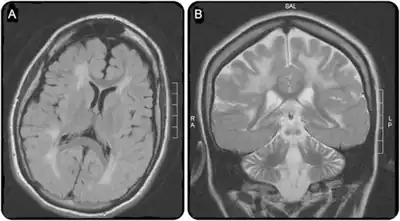 a)Extensive white matter disease  b) atrophy of frontal hemispheres and cerebellum