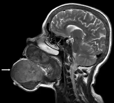 Image showed that the brown tumor originated from the mandibular and maxillar bones