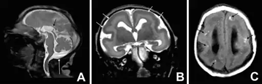 a-c)T1 and T2 image- microlissencephaly