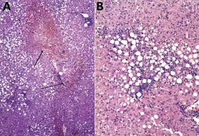 Liver biopsy sample with (fatal) human monocytic ehrlichiosis