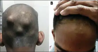 a -b) Subcutaneous nodules over the occiput and the forehead