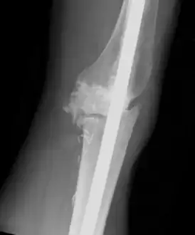 Individual with tumoral calcinosis- Lateral radiograph of the left knee demonstrating an intramedullary rod