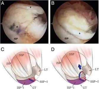 a Intraoperative arthroscopy shows the anteromedial retraction of the superficial layer (s) in a delaminated rotator cuff tear (the same case as in Fig. 1). b The retracted superficial layer was reduced posterolaterally with a tissue grasper. c The illustration shows that the anterosuperior rotator cuff is detached from the greater tuberosity (red line) and the tear progressed into the cuff substance, leading to longitudinal splitting through the supraspinatus or infraspinatus (blue line). d A larger proportion of the supraspinatus (SSP > ISP) in the superficial layer causes anteromedial retraction (type S2) (dotted line elongated rotator interval tissue, red circle end of cuff tear, SSP supraspinatus, ISP infraspinatus, GT greater tuberosity, LT lesser tuberosity, ISP-I footprint of the infraspinatus , SSP-I footprint of the supraspinatus )