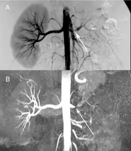 Comparison  a) Digital subtraction arteriography and b)  Unenhanced Magnetic resonance angiography  of suboclusive left renal artery stenosis arrows