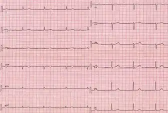 EKG shows a sinus bradycardia at 40 bpm with a first-degree atrio-ventricular block