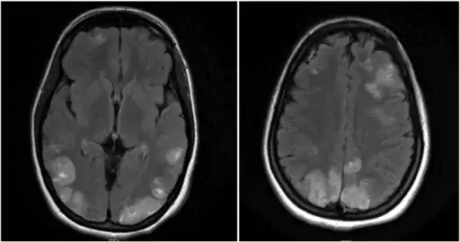 Image shows faint multifocal and bilateral hyperintensities in the frontal lobes and parietooccipital lobes, extending to the left greater than right posterior temporal regions