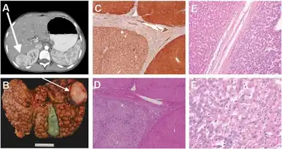 a)CT scan showing liver ( moderately differentiated hepatocellular carcinoma) b) macronodular cirrhosis (hepatocellular carcinoma-arrow) c)macronodules were immunopositive for fumarylacetoacetate hydrolase d)inactive cirrhosis (stage 4) e) tumor margin f) mild dysplasia