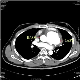MDCT aortogram suggested left aneurysm of sinus of Valsalva  and right aneurysm of sinus of Valsalva  with extension into the interventricular septum.