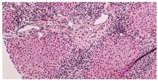 Histology of primary biliary cholangitis  × 200 liver biopsy