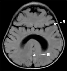 Semilobar holoprosencephaly-MRI shows incompletely interhemispheric fissure arrow 1 and partial fusion of frontal lobe arrow 2