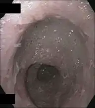 Upper endoscopy shows corkscrew esophagus