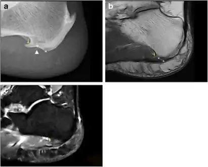 a) Plantar calcaneal spur at the origin of intrinsic muscles of the foot b) MRI confirms the presence of a calcaneal spur c) bone marrow oedema in the calcaneal spur