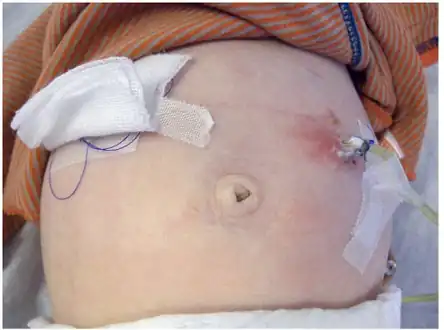 Local skin infection at the site of the jejunostomy, treated with antibiotic ointment and enterally administered antibiotics