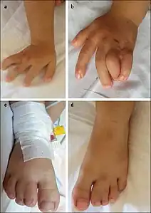 Syndactyly in a 2 1/2 year old girl with Timothy syndrome