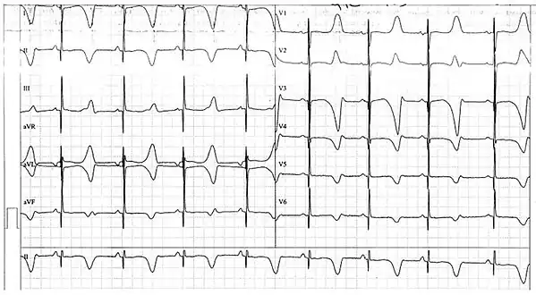 ECG from a 10-year-old boy with Jervell and Lange-Nielsen syndrome