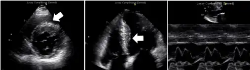Echocardiogram exam shows left atrial enlargement (asymmetrical septal hypertrophy without left ventricle (LV) outflow tract obstruction, restrictive filling pattern, normal LV systolic function)