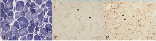 d) Multi-minicores  in a LGMD2A person e) immunohistochemical labelling of N-terminal dystrophin shows decreased or absent expression  in a LGMD2A person  f) immunohistochemical labelling of dysferlin shows decreased expression in a LGMD2A person