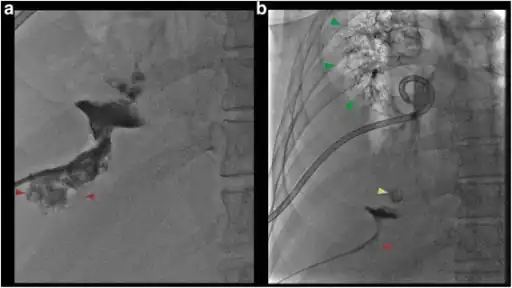 a) Fluoroscopic view shows contrast in collapsed liver abscess red arrow b) fluoroscopic view shows contrast tracking from the liver abscess red arrow